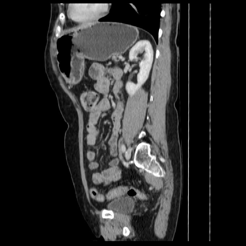 Bosniak renal cyst - type IV (Radiopaedia 22929-22953 G 49).jpg