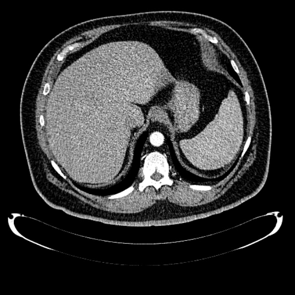 File:Bosniak renal cyst - type IV (Radiopaedia 24244-24518 B 51).jpg