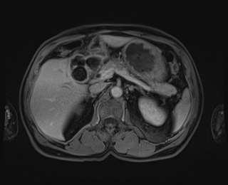 Bouveret syndrome (Radiopaedia 61017-68856 Axial T1 C+ fat sat 31).jpg