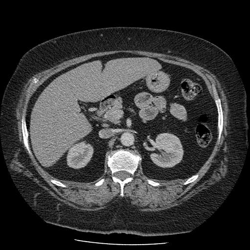 Bovine aortic arch - right internal mammary vein drains into the superior vena cava (Radiopaedia 63296-71875 A 202).jpg
