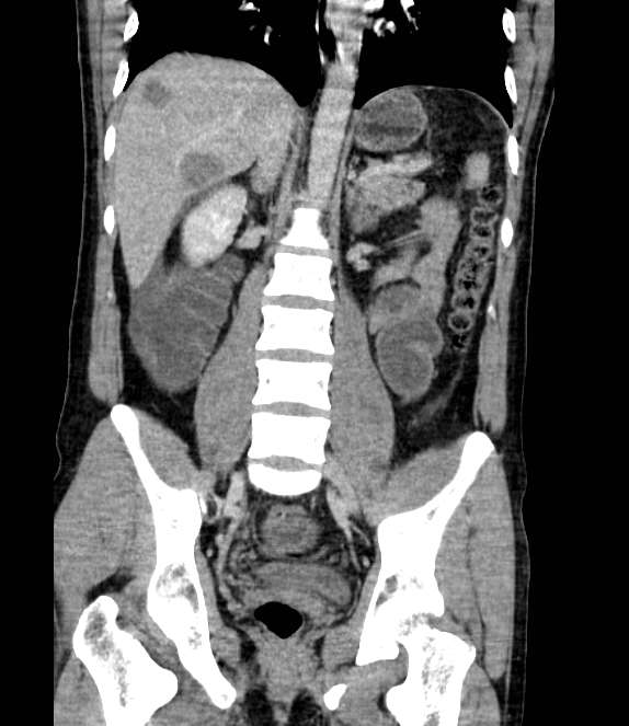 Bowel obstruction from colon carcinoma (Radiopaedia 22995-23028 C 46).jpg