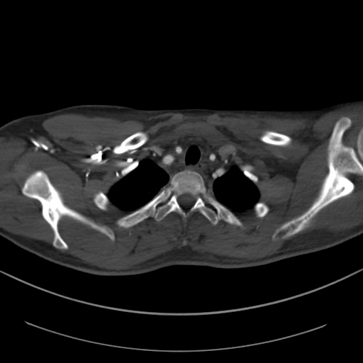Brachiocephalic trunk pseudoaneurysm (Radiopaedia 70978-81191 Axial bone window 48).jpg