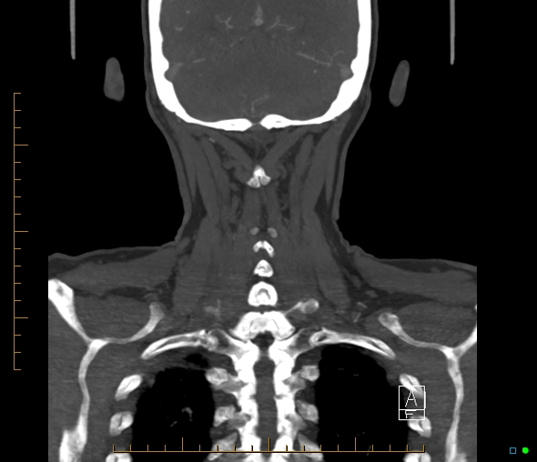 Brachiocephalic trunk stenosis (Radiopaedia 87242-103519 B 59).jpg