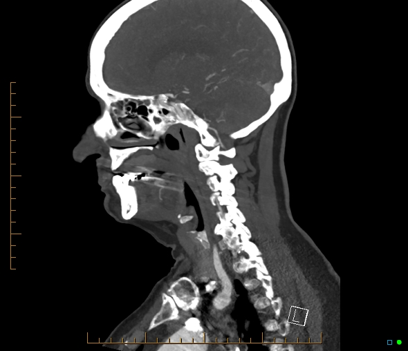Brachiocephalic trunk stenosis (Radiopaedia 87242-103519 C 39).jpg