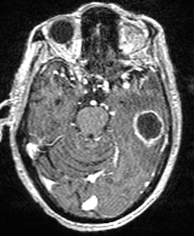 Brain abscess with dual rim sign (Radiopaedia 87566-103938 Axial T1 C+ 61).jpg