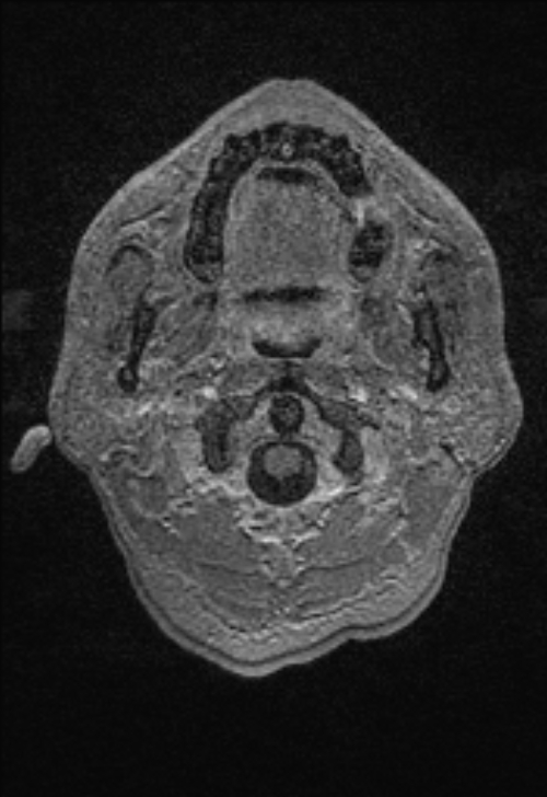 Brain abscess with ventriculitis (Radiopaedia 85703-101495 Axial T1 C+ 7).jpg