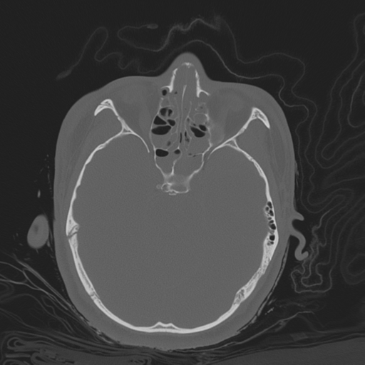 File:Brain contusions, internal carotid artery dissection and base of skull fracture (Radiopaedia 34089-35339 Axial bone window 62).png