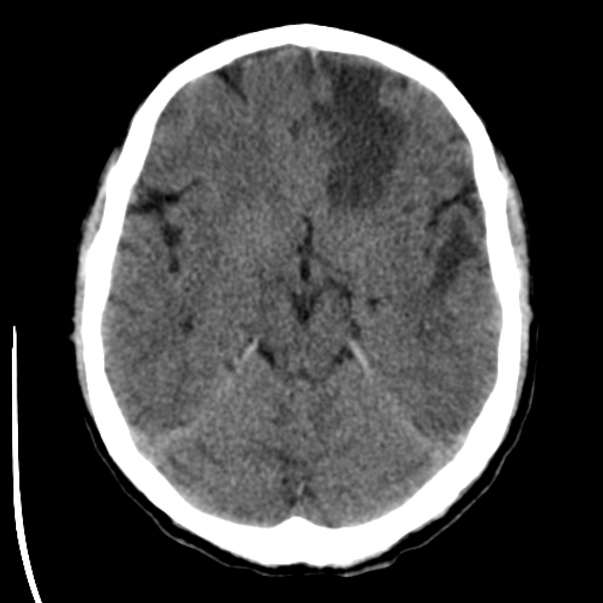 Brain metastases from lung cancer (Radiopaedia 24480-24781 Axial non-contrast 17).jpg