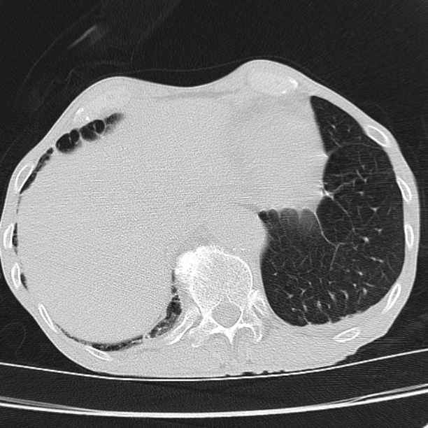 Brain metastases from lung cancer (Radiopaedia 27849-28093 Axial lung window 56).jpg