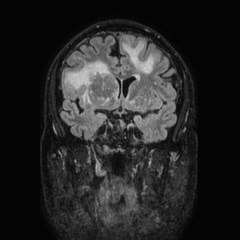 Brain metastases from lung cancer (Radiopaedia 83839-99028 Coronal FLAIR 31).jpg