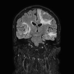 Brain metastases from lung cancer (Radiopaedia 83839-99028 Coronal FLAIR 43).jpg