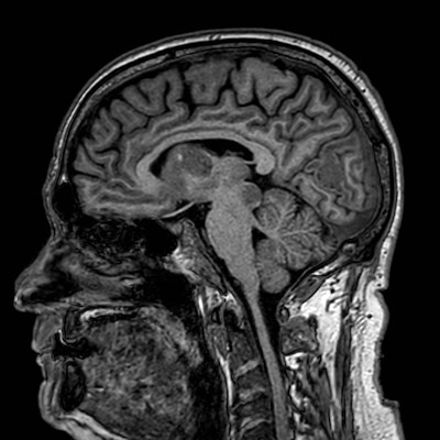 Brain metastases from lung cancer (Radiopaedia 83839-99028 Sagittal T1 60).jpg