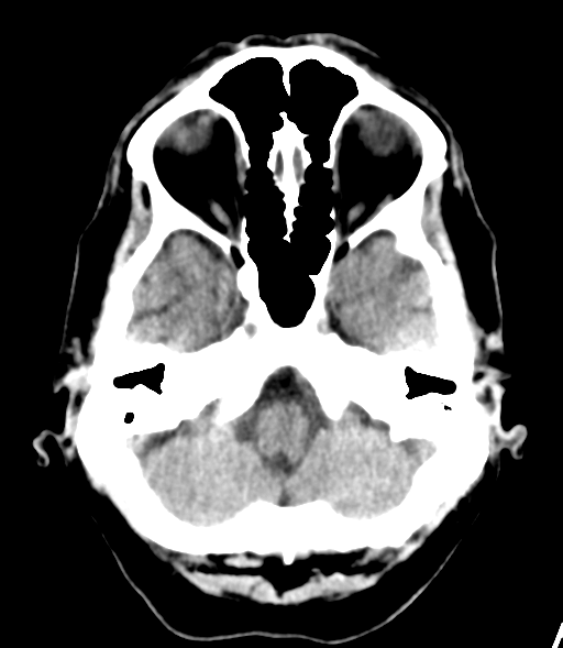 File:Brain metastasis (lung cancer) (Radiopaedia 48289-53177 Axial non-contrast 5).png