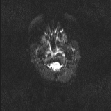 Brainstem glioma (Radiopaedia 67531-76922 Axial DWI 3).jpg