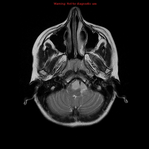 File:Brainstem glioma (Radiopaedia 9444-10124 Axial T2 3).jpg