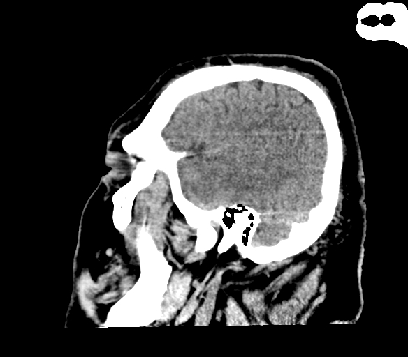 Brainstem hemorrhage (Radiopaedia 81294-94976 C 10).jpg