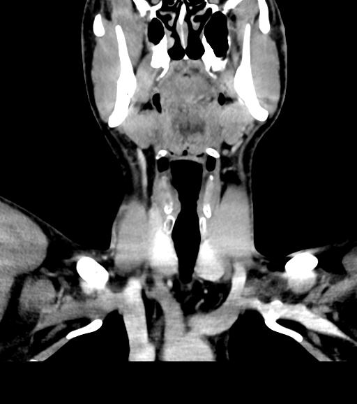 Branchial cleft cyst (Radiopaedia 31167-31875 Coronal C+ delayed 27).jpg