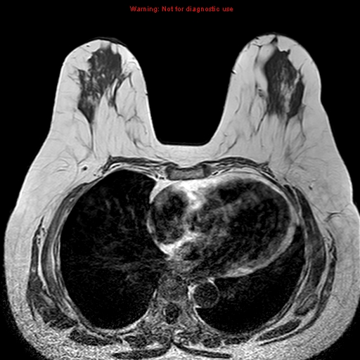 File:Breast carcinoma (multicentric multifocal in mammary Paget disease) (Radiopaedia 50966-56512 Axial T1 5).jpg