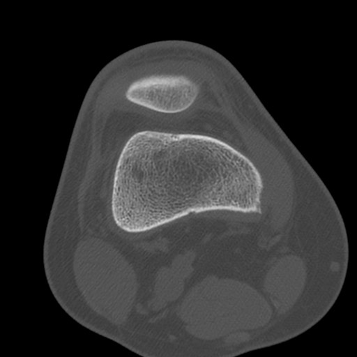 Brodie abscess of the tibia (Radiopaedia 58984-66250 Axial bone window 19).jpg