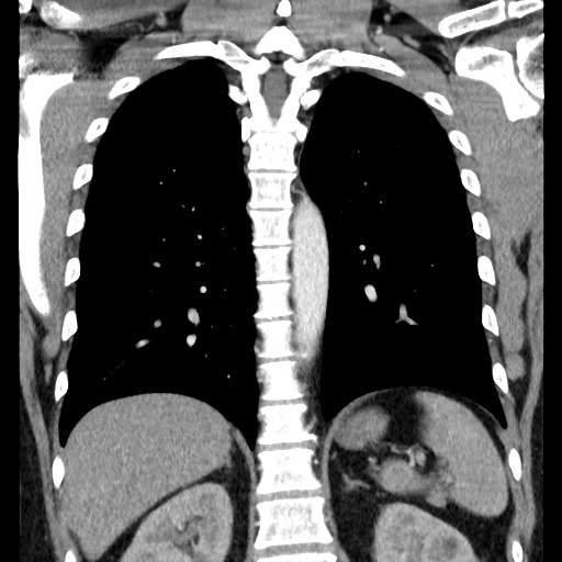 Bronchial carcinoid tumor (Radiopaedia 67377-76764 C 46).jpg