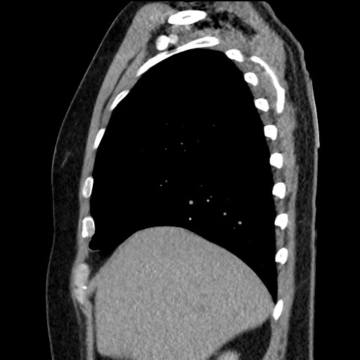 File:Bronchial carcinoid tumor (Radiopaedia 67377-76764 E 16).jpg