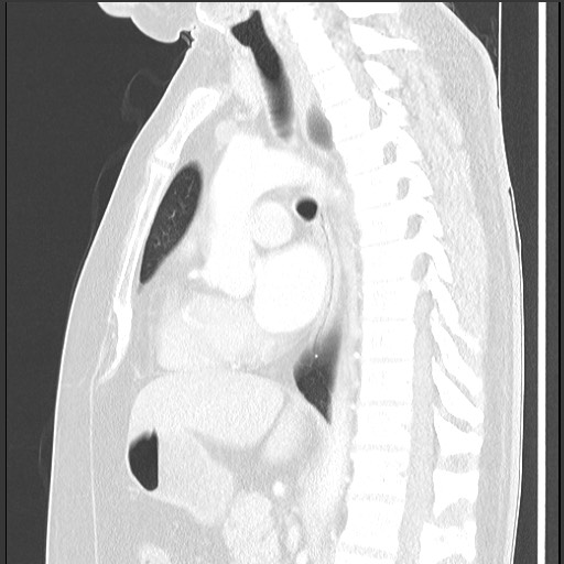 Bronchial carcinoid tumor (Radiopaedia 67377-76764 Sagittal lung window 36).jpg