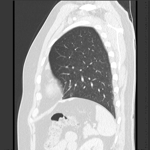 Bronchial carcinoid tumor (Radiopaedia 67377-76764 Sagittal lung window 55).jpg