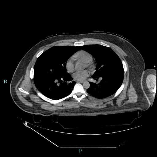 Bronchial carcinoid tumor (Radiopaedia 78272-90870 Axial non-contrast 56).jpg