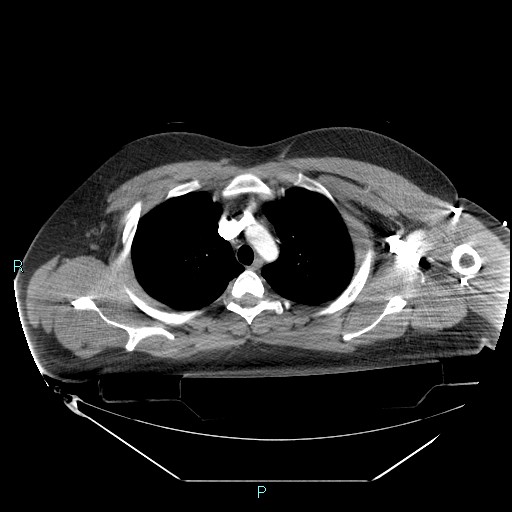 File:Bronchial carcinoid tumor (Radiopaedia 78272-90870 B 35).jpg
