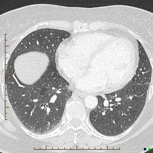 Bronchial diverticula (Radiopaedia 79512-92676 Axial lung window 132).jpg