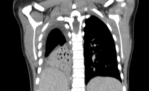 Bronchial mucoepidermoid carcinoma (Radiopaedia 57023-63895 Coronal 103).jpg