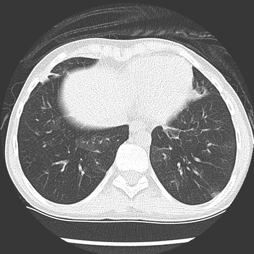 Bronchiolotis obliterans (Radiopaedia 73769-84575 Axial lung window 37).jpg