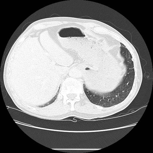 Bronchocele (Radiopaedia 17097-16795 Axial lung window 105).jpg