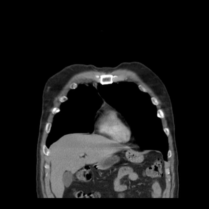 Bronchogenic carcinoma with upper lobe collapse (Radiopaedia 29297-29726 D 14).jpg