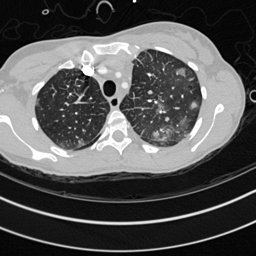 Bronchogenic cyst (Radiopaedia 77801-90071 Axial lung window 8).jpg