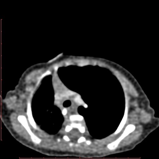 Bronchogenic cyst (Radiopaedia 78599-91409 B 67).jpg