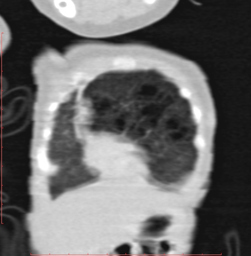 Bronchogenic cyst (Radiopaedia 78599-91409 Coronal lung window 36).jpg