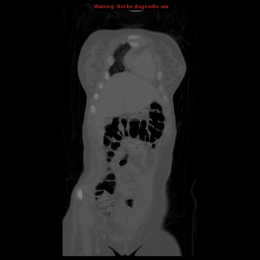 Brown tumor (Radiopaedia 12318-12596 D 17).jpg