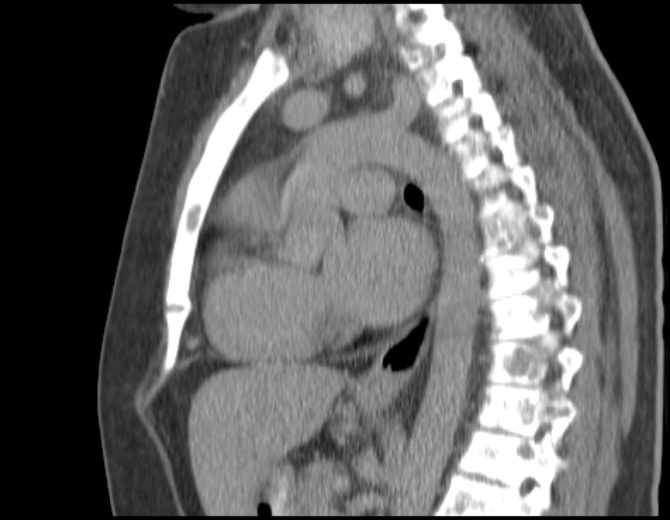 Brown tumors compressing the spinal cord (Radiopaedia 68442-77988 B 33).jpg