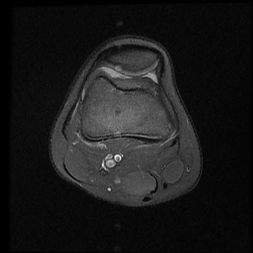 File:Bucket handle tear - lateral meniscus (Radiopaedia 72124-82634 Axial PD fat sat 2).jpg