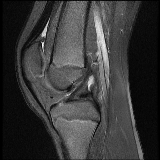 File:Bucket handle tear - lateral meniscus (Radiopaedia 72124-82634 Sagittal PD fat sat 8).jpg