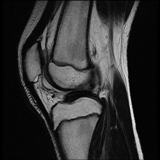 File:Bucket handle tear - lateral meniscus (Radiopaedia 72124-82634 Sagittal T2 7).jpg