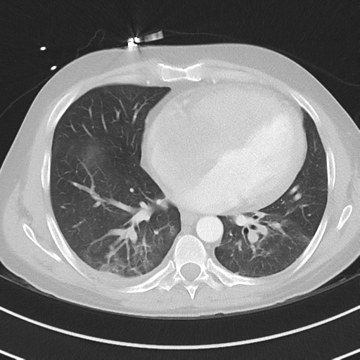 Burkitt lymphoma (Radiopaedia 34686-36121 Axial lung window 31).png