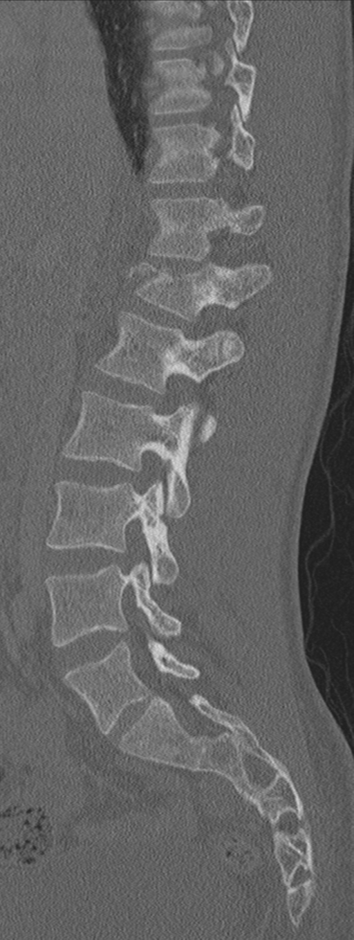 Burst fracture - T12 with conus compression (Radiopaedia 56825-63647 Sagittal bone window 52).png