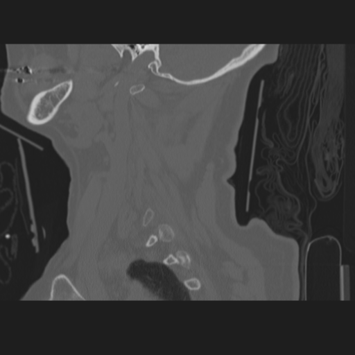 C2 fracture (Radiopaedia 34091-35341 Sagittal bone window 16).png