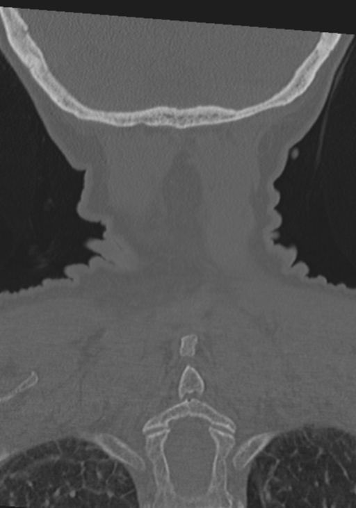C2 fracture with vertebral artery dissection (Radiopaedia 37378-39199 Coronal bone window 52).png