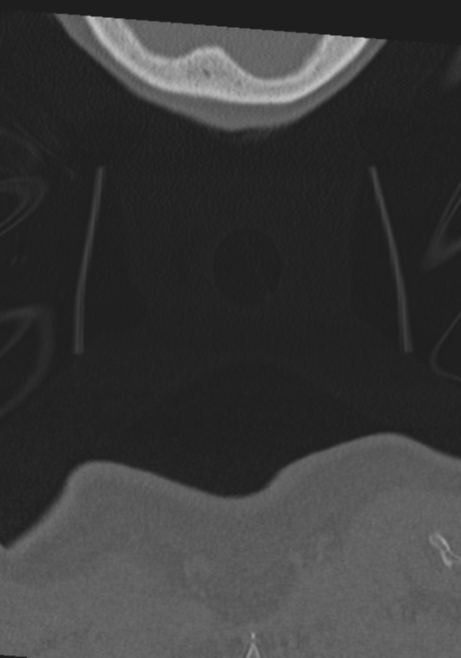 C2 fracture with vertebral artery dissection (Radiopaedia 37378-39199 Coronal bone window 76).png