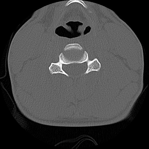 File:C5 facet fracture (Radiopaedia 58374-65499 Axial bone window 50).jpg