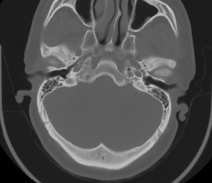 C7 laminar fracture and Klippel-Feil syndrome (Radiopaedia 86710-102850 Axial bone window 13).jpg