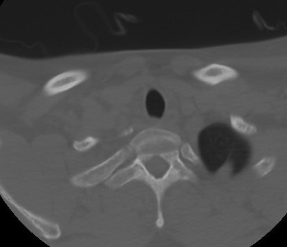 File:C7 laminar fracture and Klippel-Feil syndrome (Radiopaedia 86710-102850 Axial bone window 69).jpg